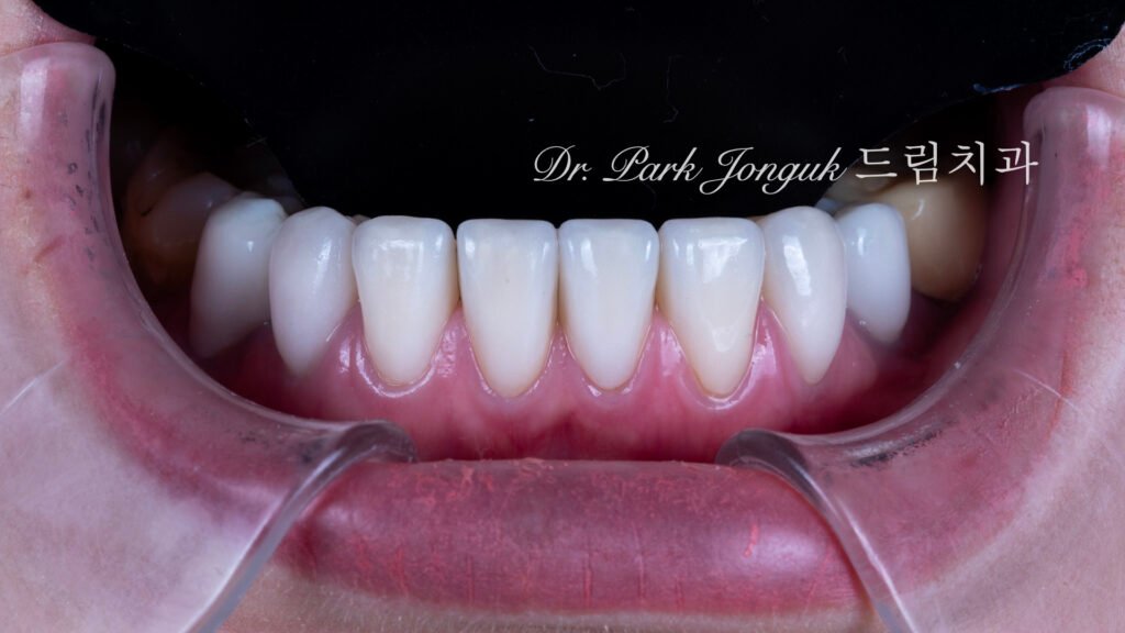 자연스러운 라미네이트