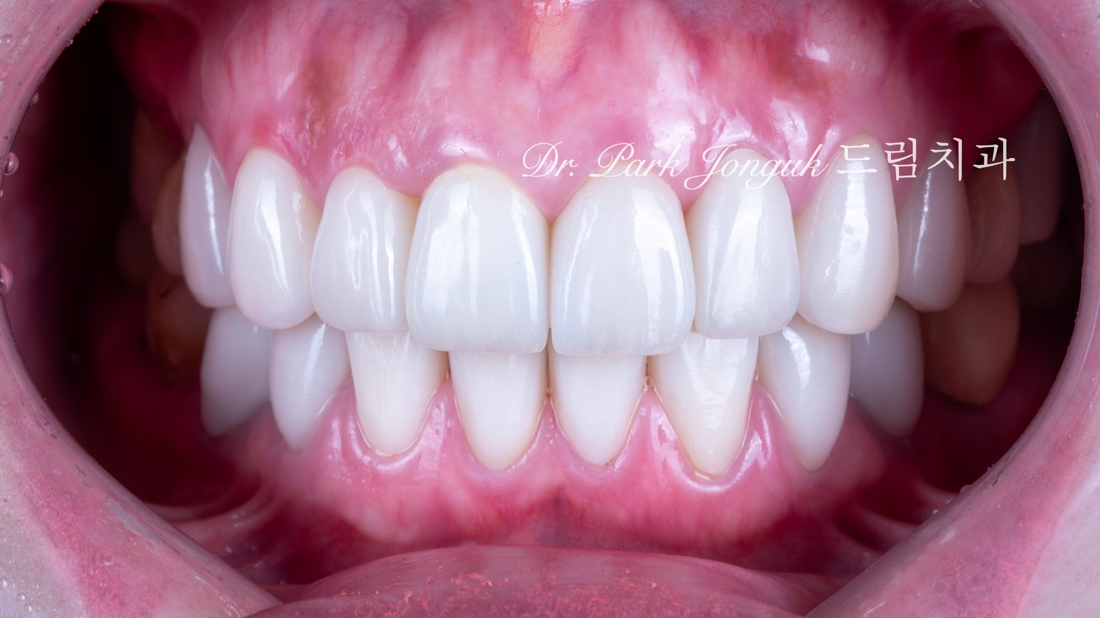 자연스러운 라미네이트