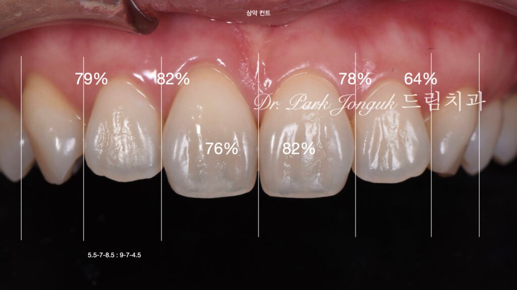 치아변색 치아형태로 라미네이트 치료를 위해 내원