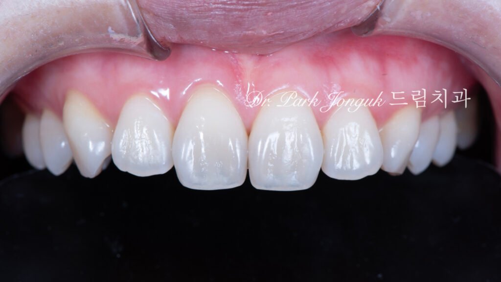 치아변색 치아형태로 라미네이트 치료를 위해 내원