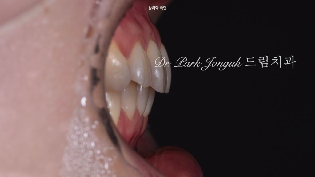 치아변색 치아형태로 라미네이트 치료를 위해 내원