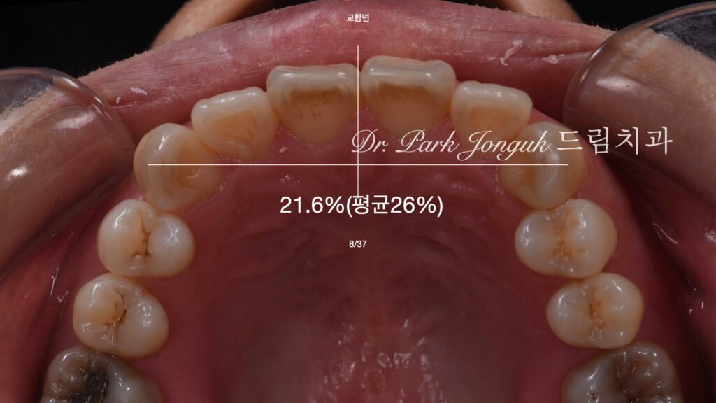 치아변색 치아형태로 라미네이트 치료를 위해 내원