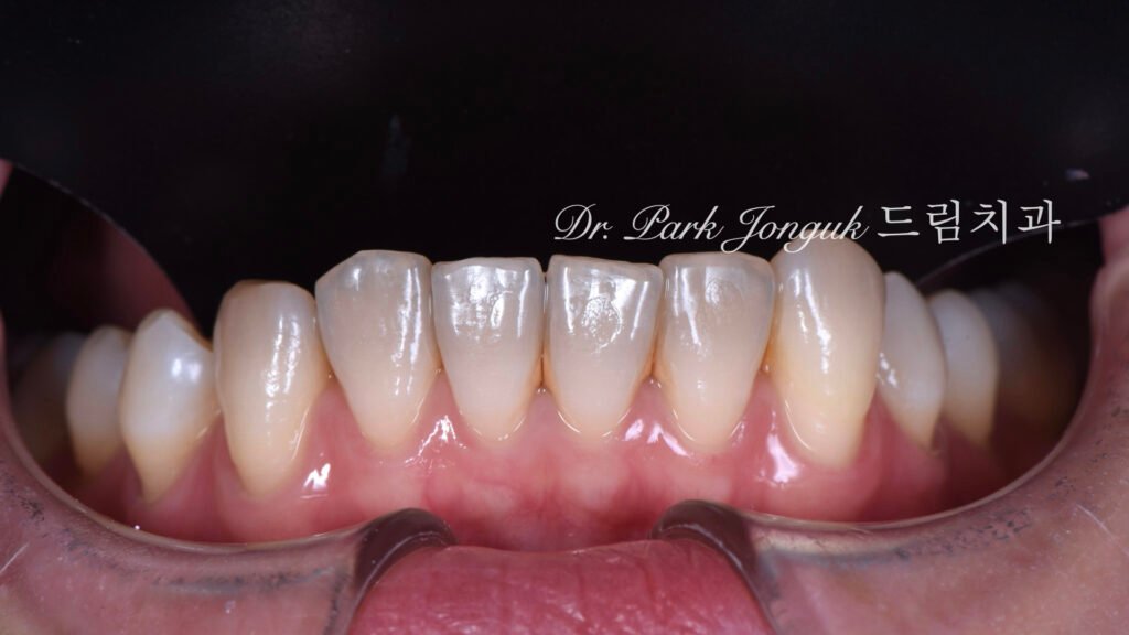 치아변색 치아형태로 라미네이트 치료를 위해 내원