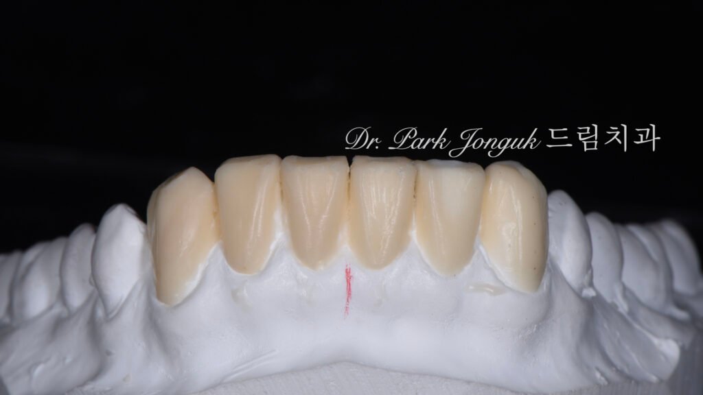 치아변색 치아형태로 라미네이트 치료를 위해 내원