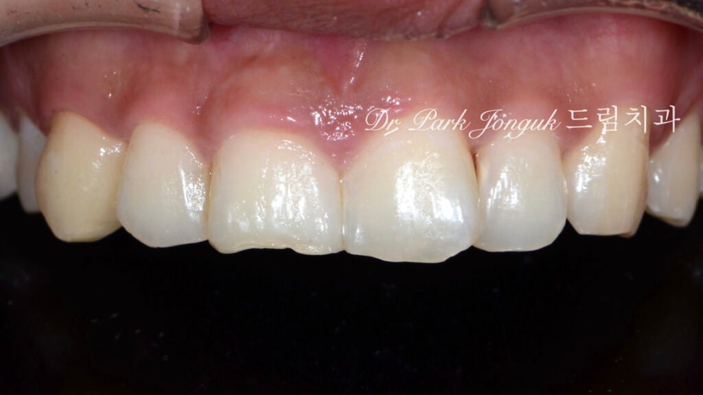 앞니 비대칭 큰 앞니로 라미네이트 치료를 위해 내원
