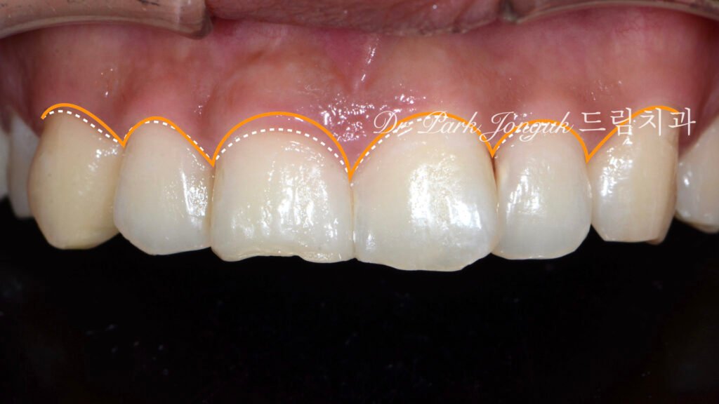 앞니 비대칭 큰 앞니로 라미네이트 치료를 위해 내원