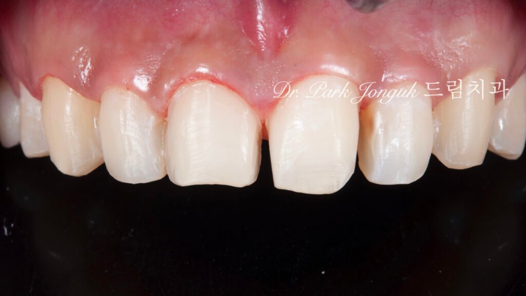 앞니 비대칭 큰 앞니로 라미네이트 치료를 위해 내원