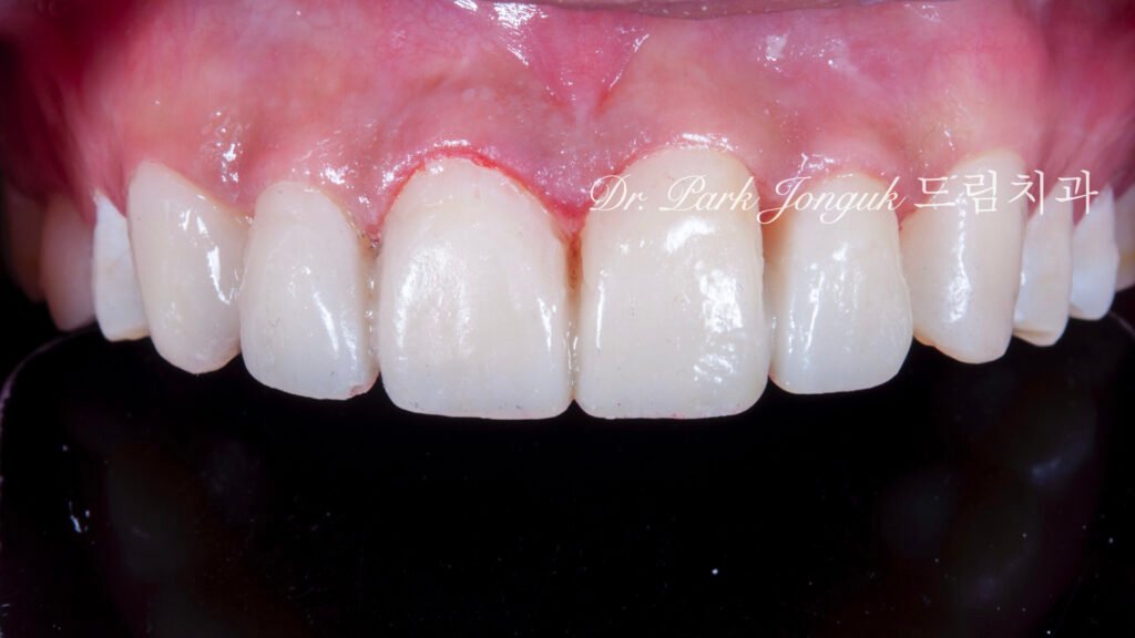 앞니 비대칭 큰 앞니로 라미네이트 치료를 위해 내원