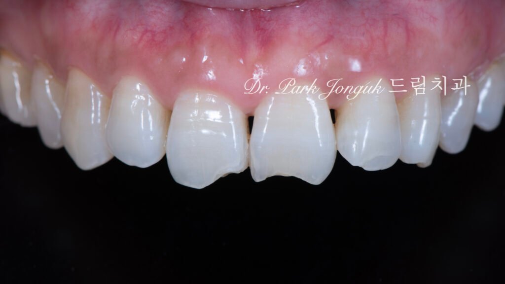 60대-블랙트라이앵글-깨진치아-치료전