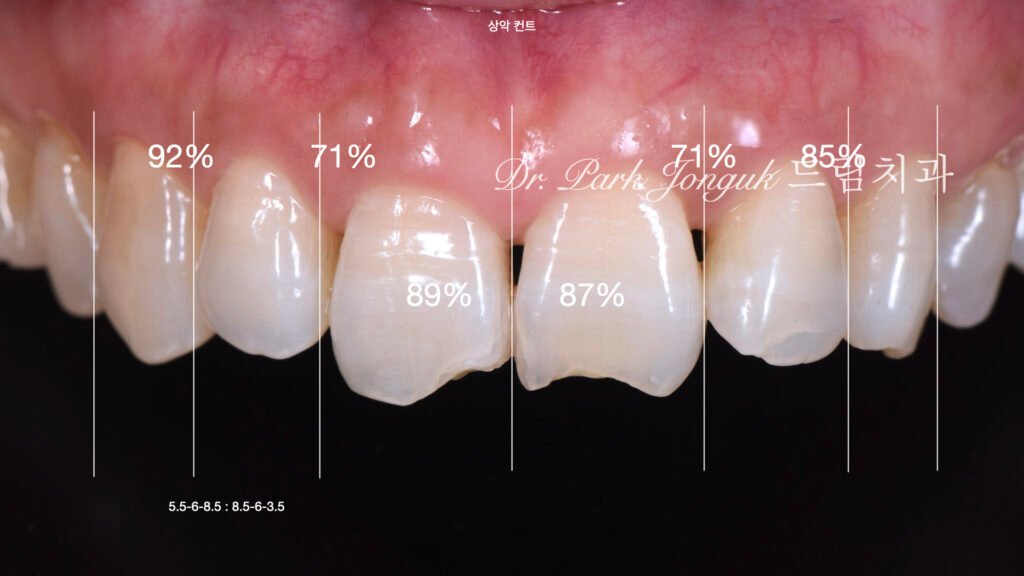 60대-라미네이트-치아크기비율-진단