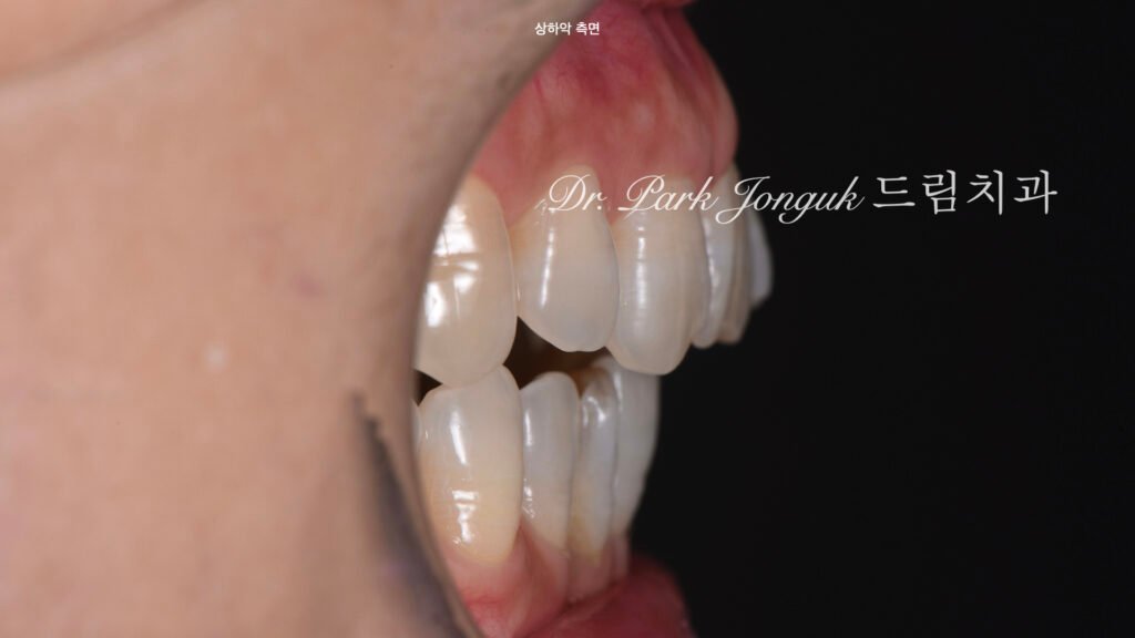 블랙트라이앵글-왁스업-진단