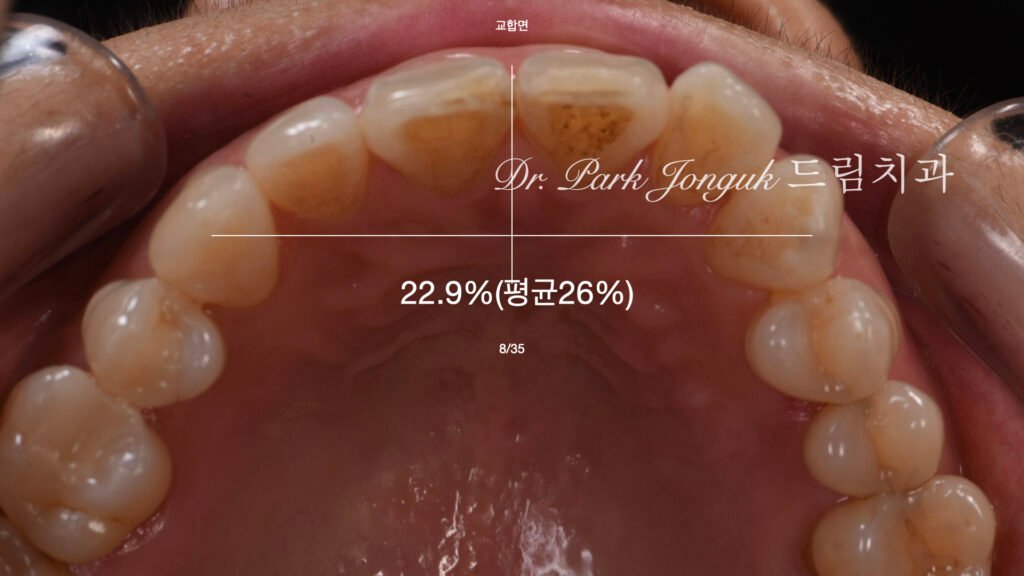 블랙트라이앵글-왁스업-진단