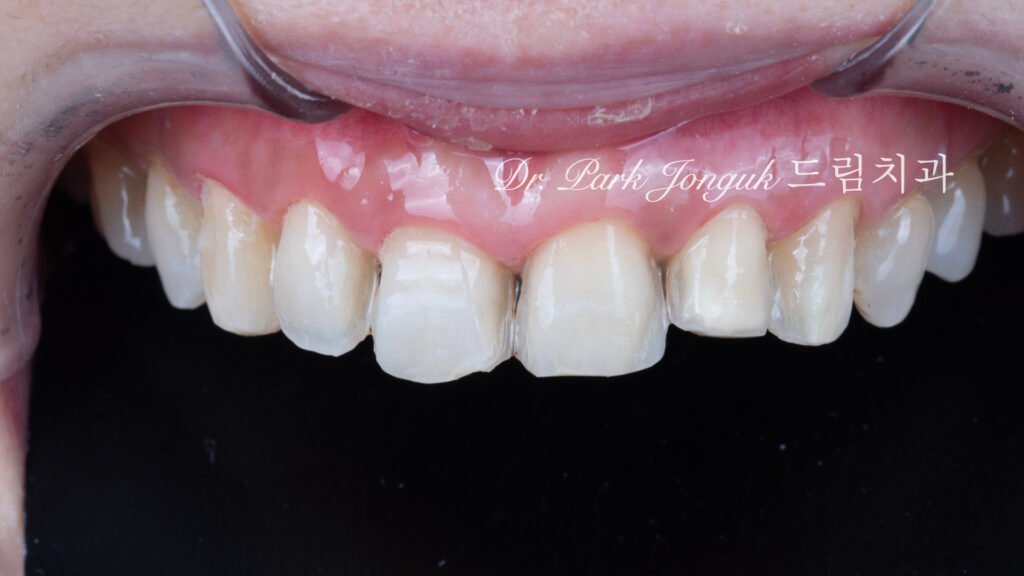 60대-라미네이트-전략적삭제