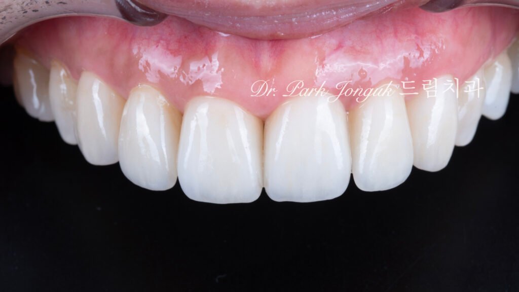 60대-라미네이트-자연스러운결과