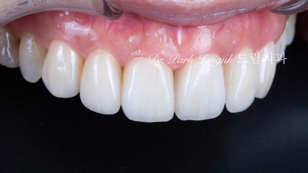 60대-라미네이트-자연스러운결과