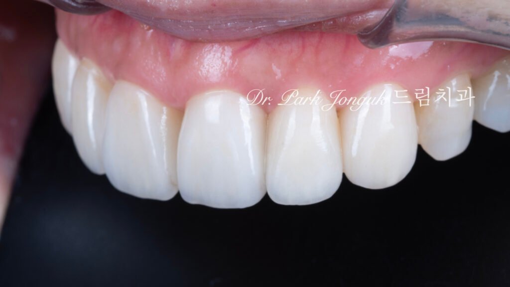 60대-라미네이트-자연스러운결과