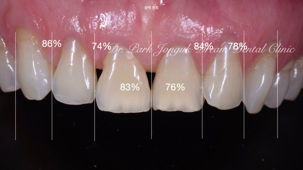 블랙트라이앵글의 라미네이트 치료