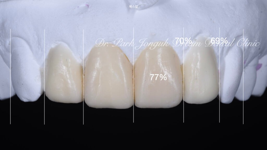 블랙트라이앵글의 라미네이트 치료