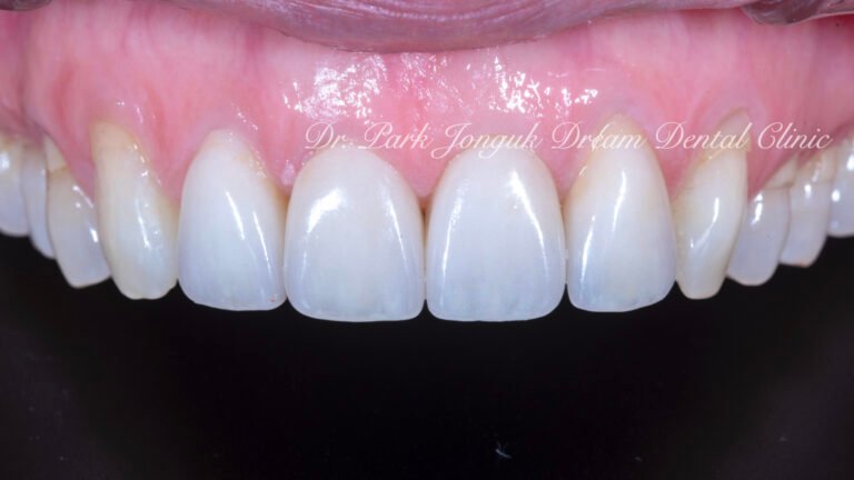 블랙트라이앵글의 라미네이트 치료