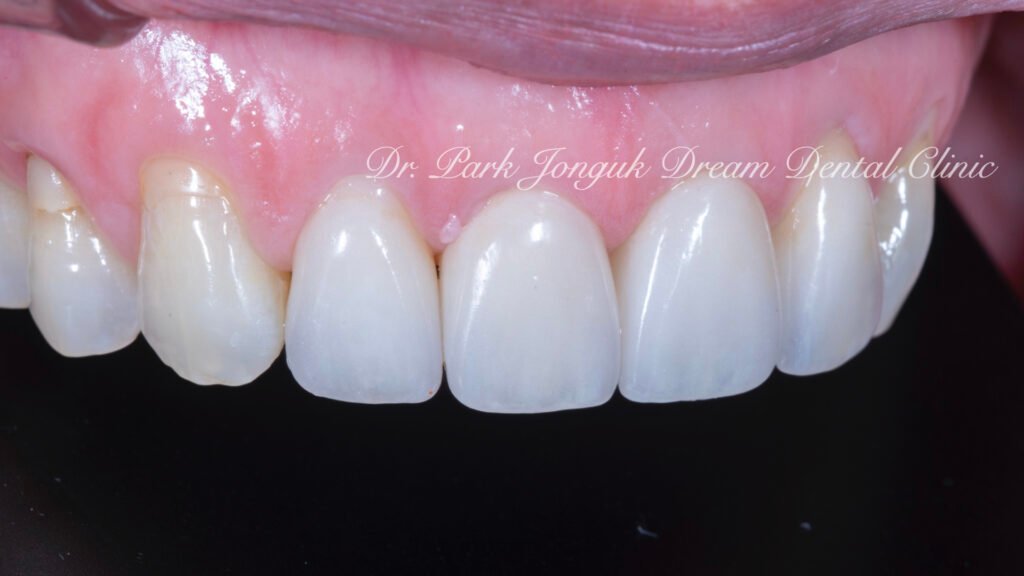 블랙트라이앵글의 라미네이트 치료