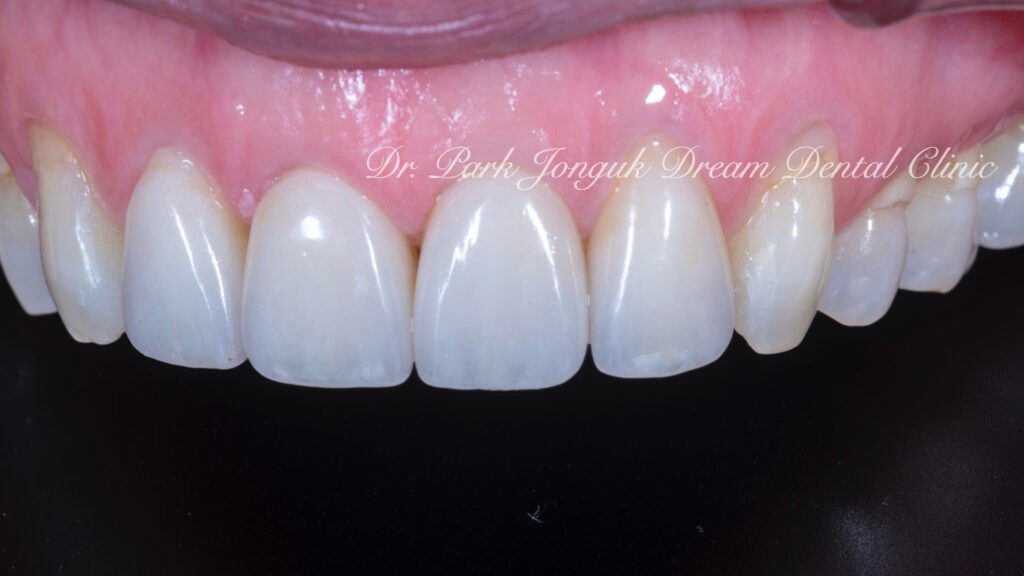 블랙트라이앵글의 라미네이트 치료