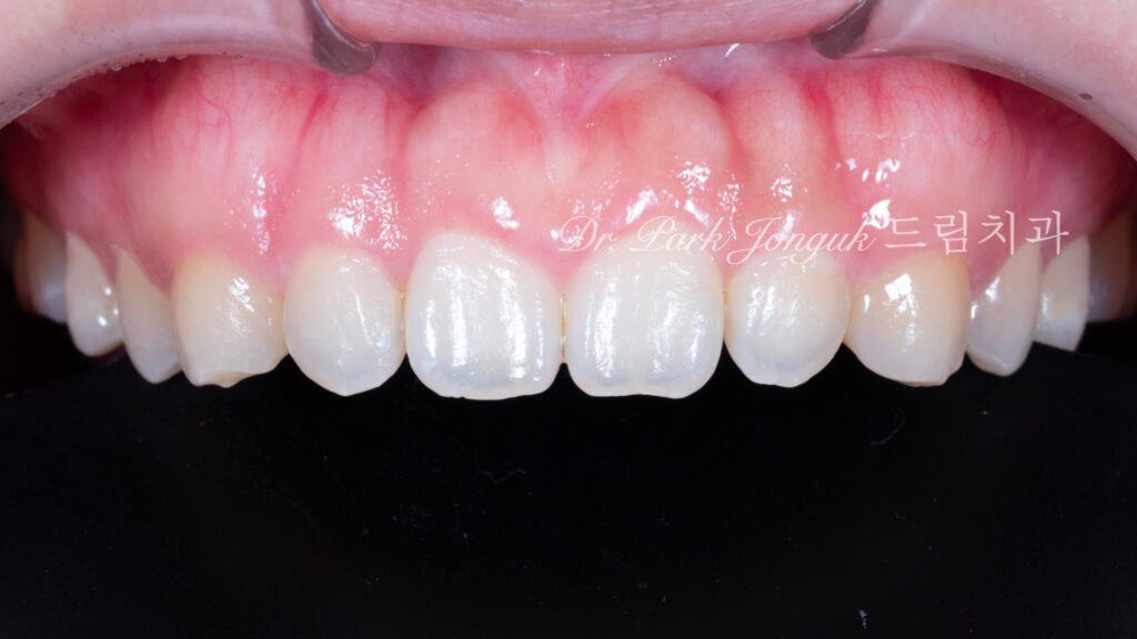 교정후 옥니 무삭제 라미네이트