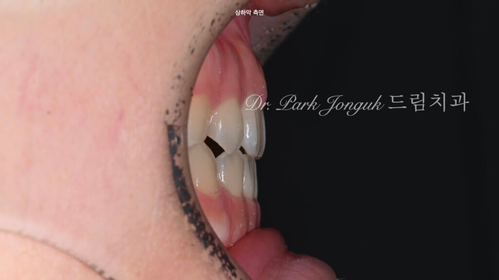 교정후 옥니 무삭제 라미네이트