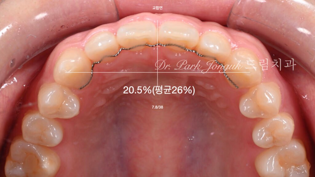 교정후 옥니 무삭제 라미네이트