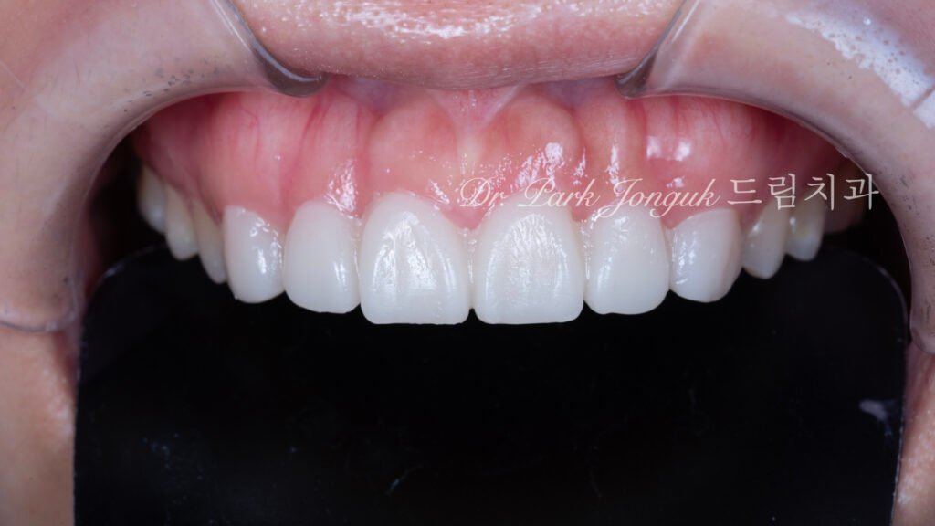 교정후 옥니 무삭제 라미네이트