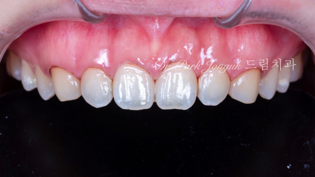 교정후 옥니 무삭제 라미네이트