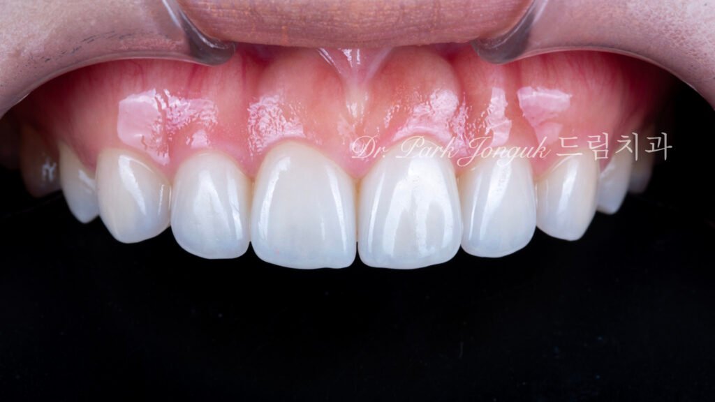 교정후 옥니 무삭제 라미네이트