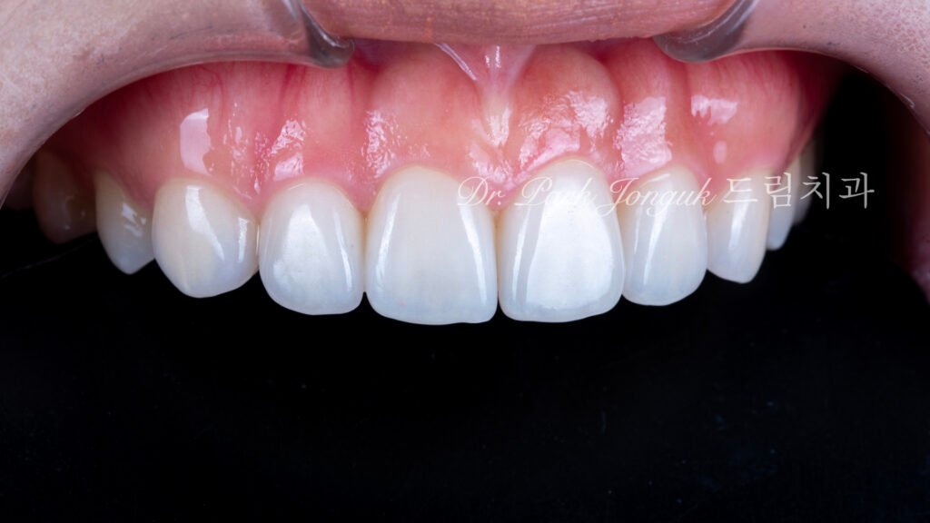 교정후 옥니 무삭제 라미네이트