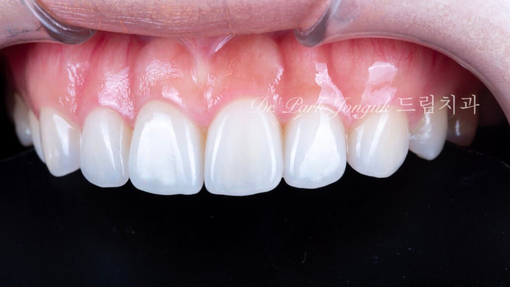 교정후 옥니 무삭제 라미네이트