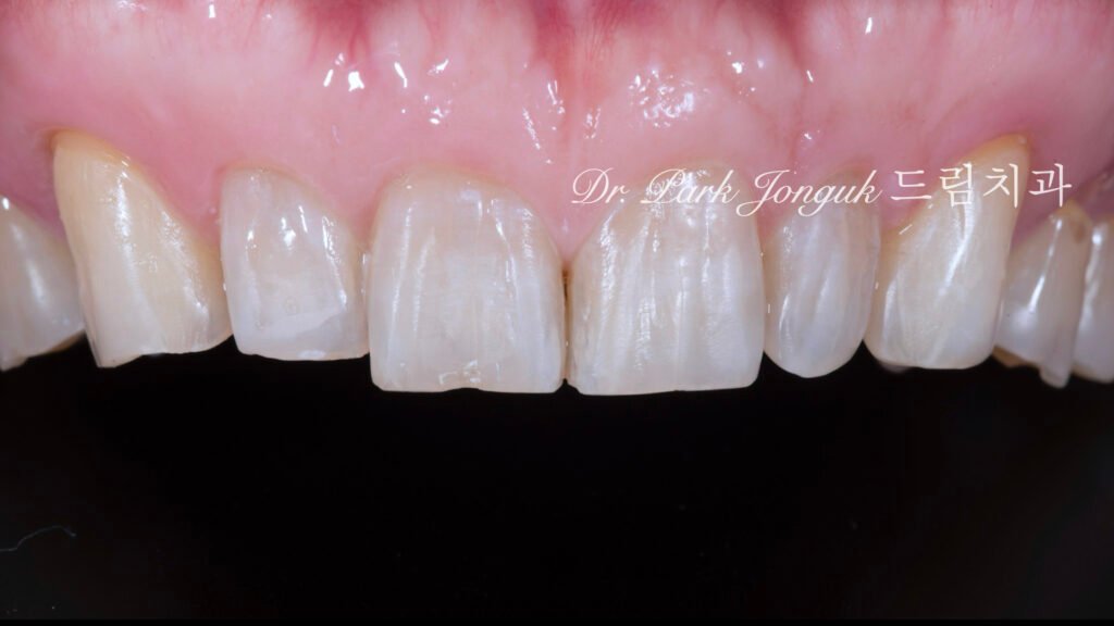 최소침습-삭제후-거의차이없음