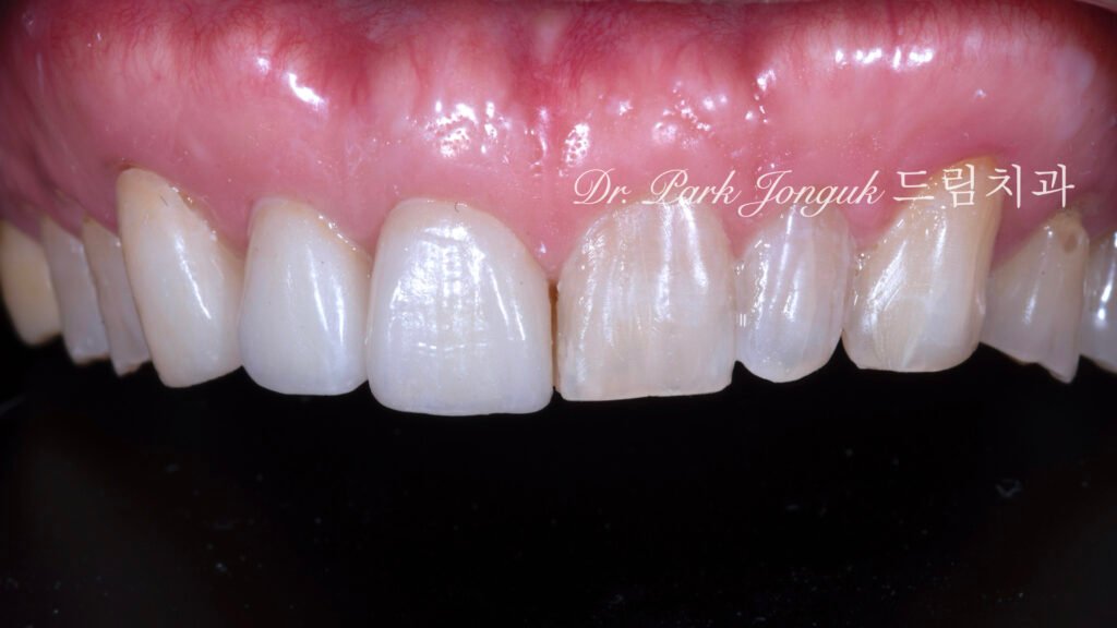 편측장착-변화비교