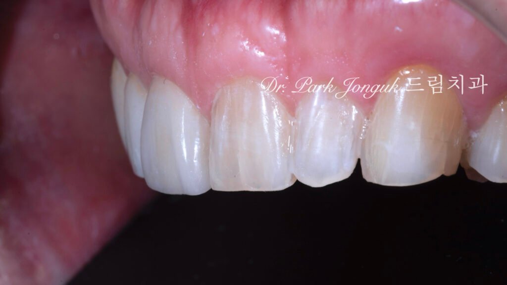 편측장착-변화비교