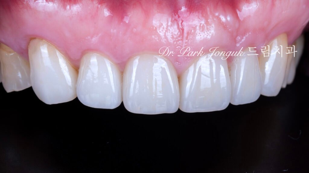 5년추적-장기안정성-검증