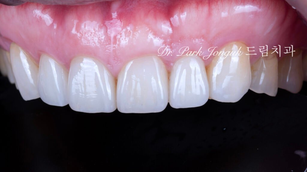 5년추적-장기안정성-검증