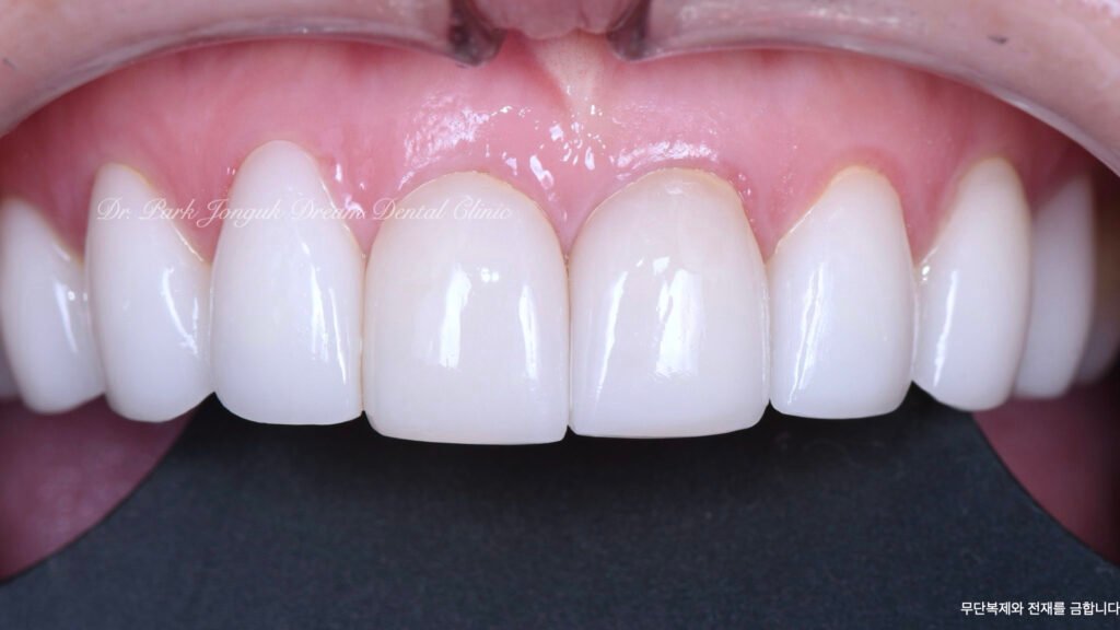 라미네이트 제작 방식에 따른 차이