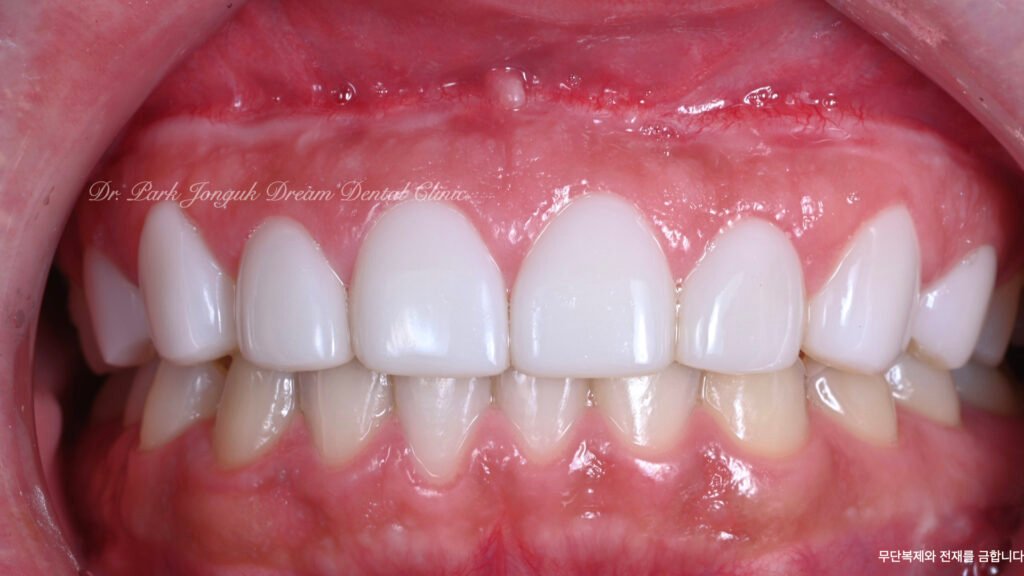 라미네이트 제작 방식에 따른 차이