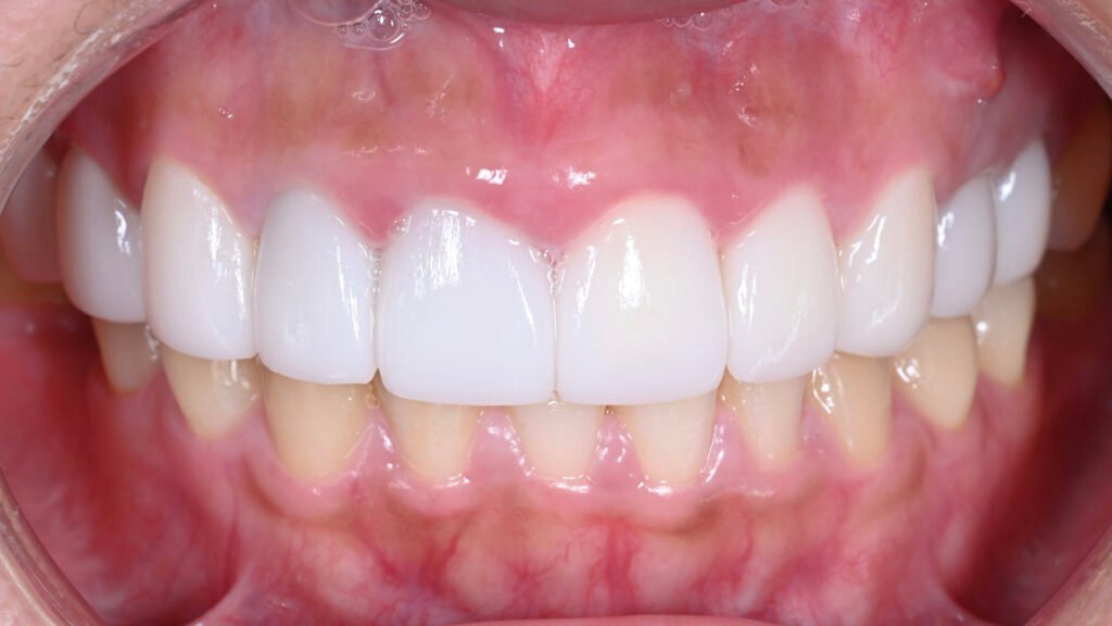 라미네이트 제작 방식에 따른 차이