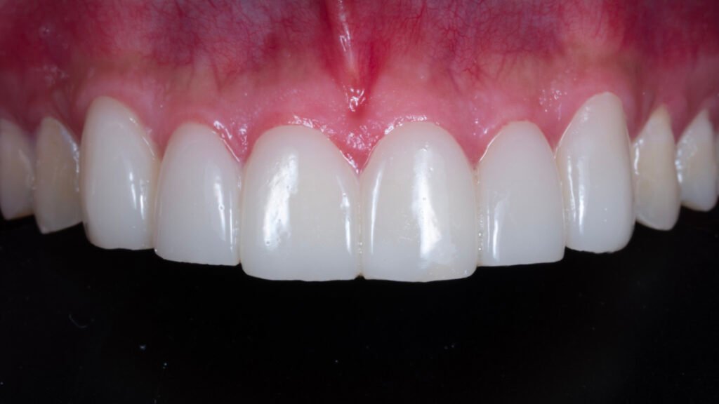 라미네이트 제작 방식에 따른 차이