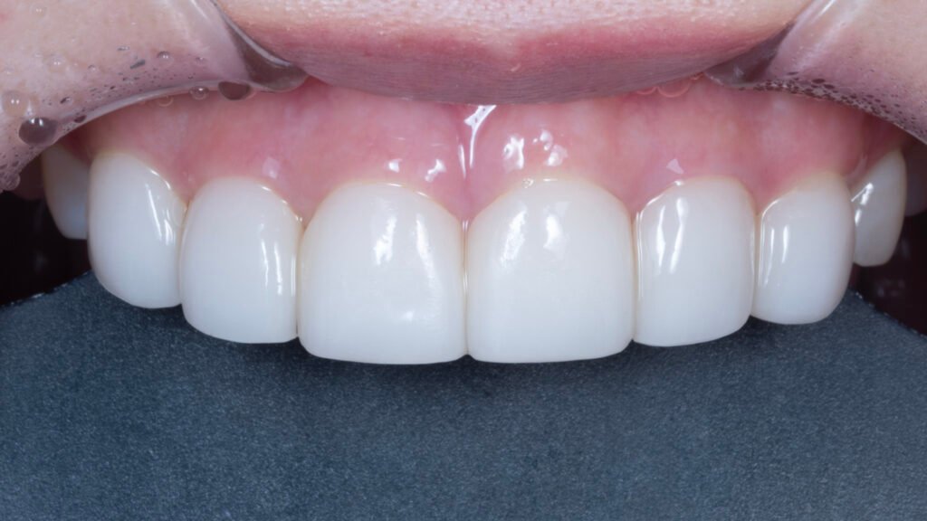 라미네이트 제작 방식에 따른 차이