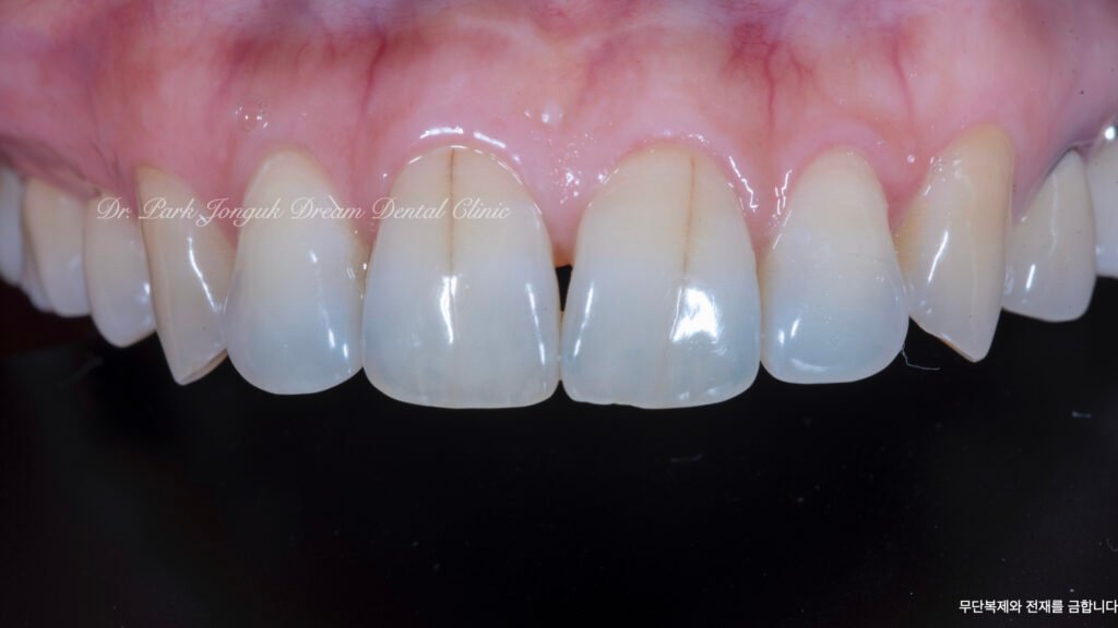 라미네이트 제작 방식에 따른 차이