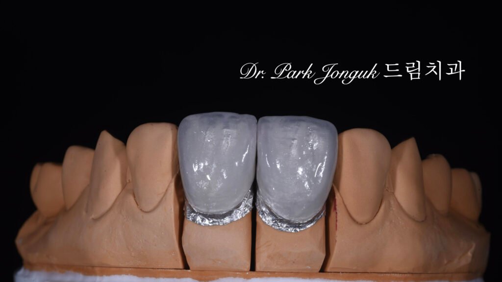 라미네이트 제작 방식에 따른 차이