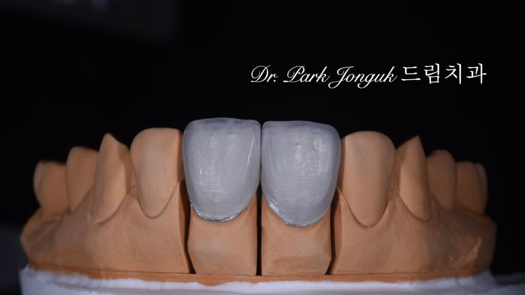 라미네이트 제작 방식에 따른 차이