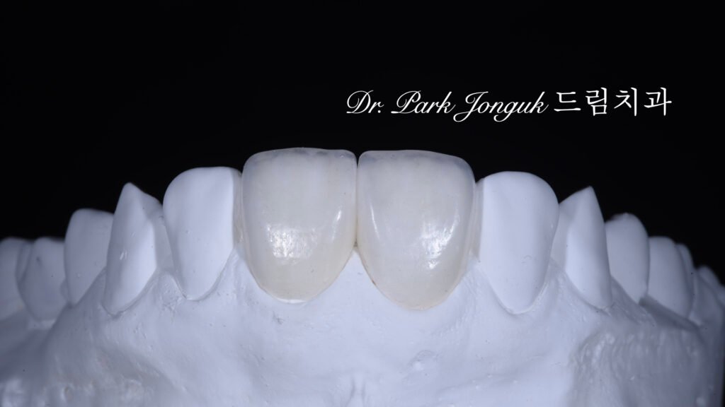 라미네이트 제작 방식에 따른 차이