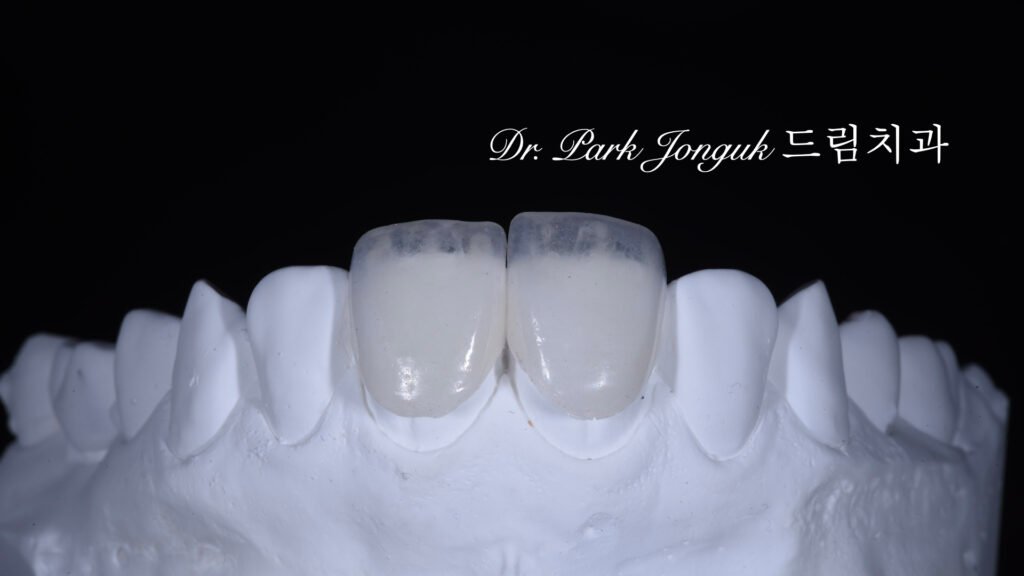 라미네이트 제작 방식에 따른 차이