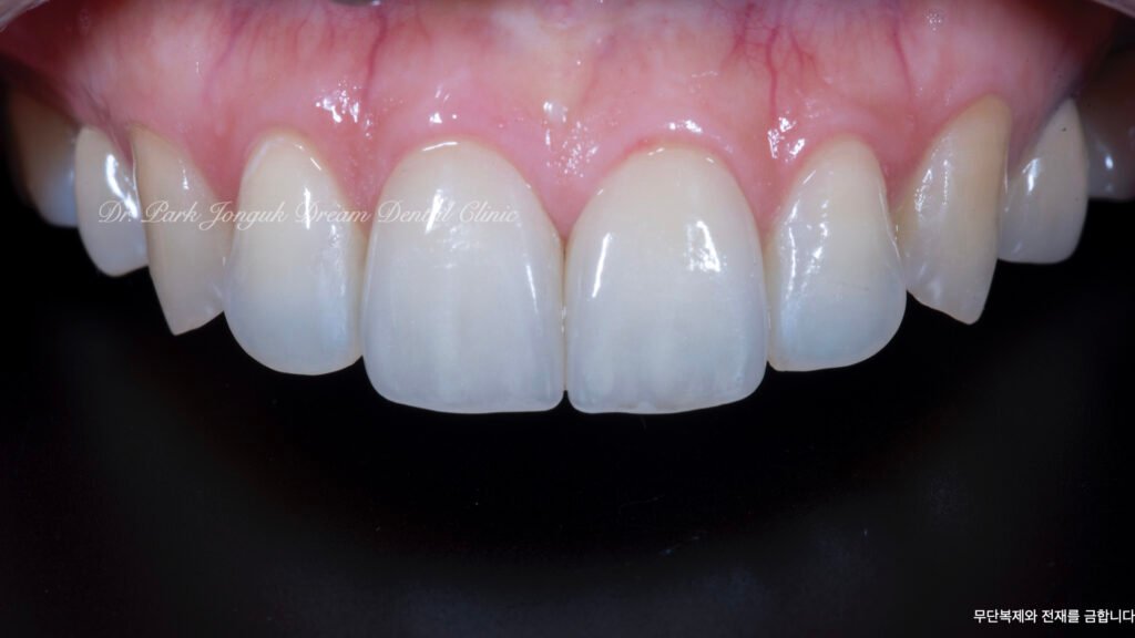 라미네이트 제작 방식에 따른 차이