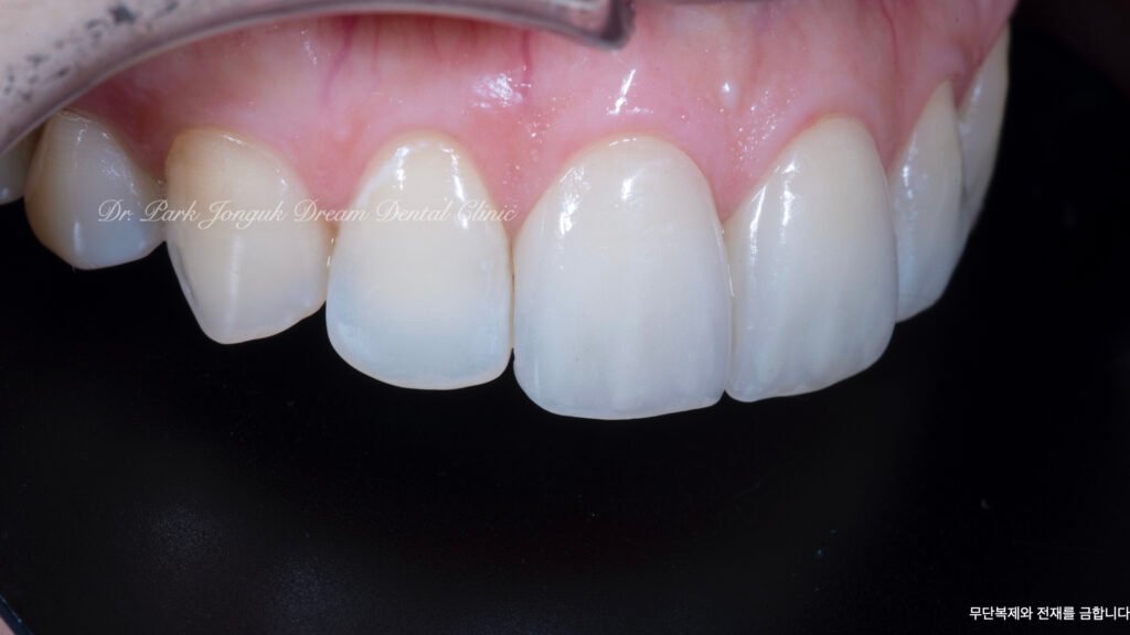 라미네이트 제작 방식에 따른 차이